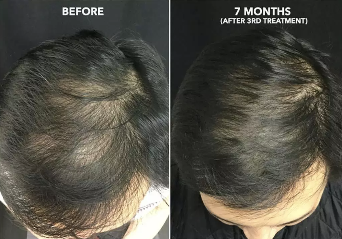 Hair Restoration | Elegance Medical Aesthetics – Botox, Cosmetic and